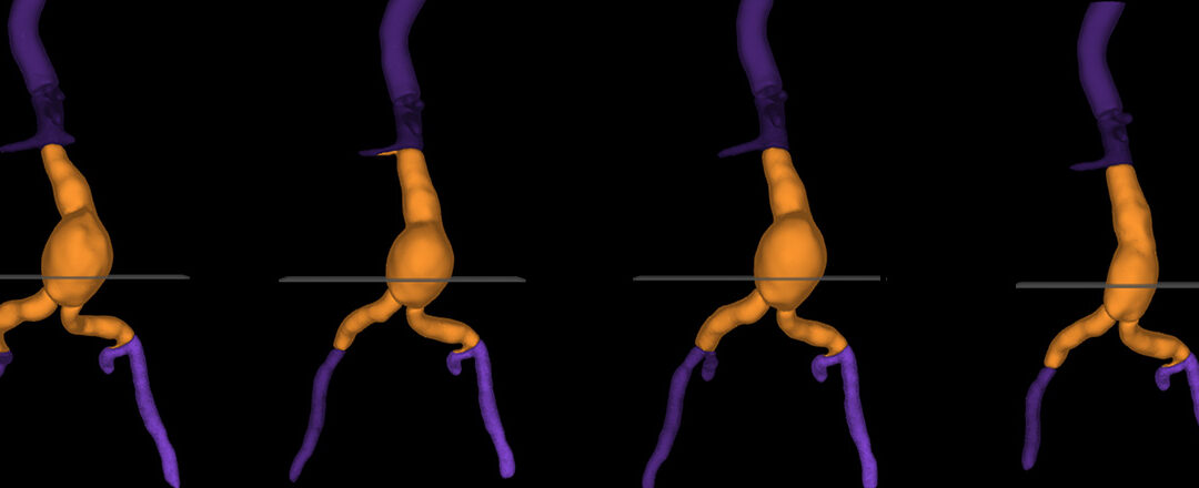 Introducing AVA: Cydar’s new aortic Automatic Volume Assessment tool